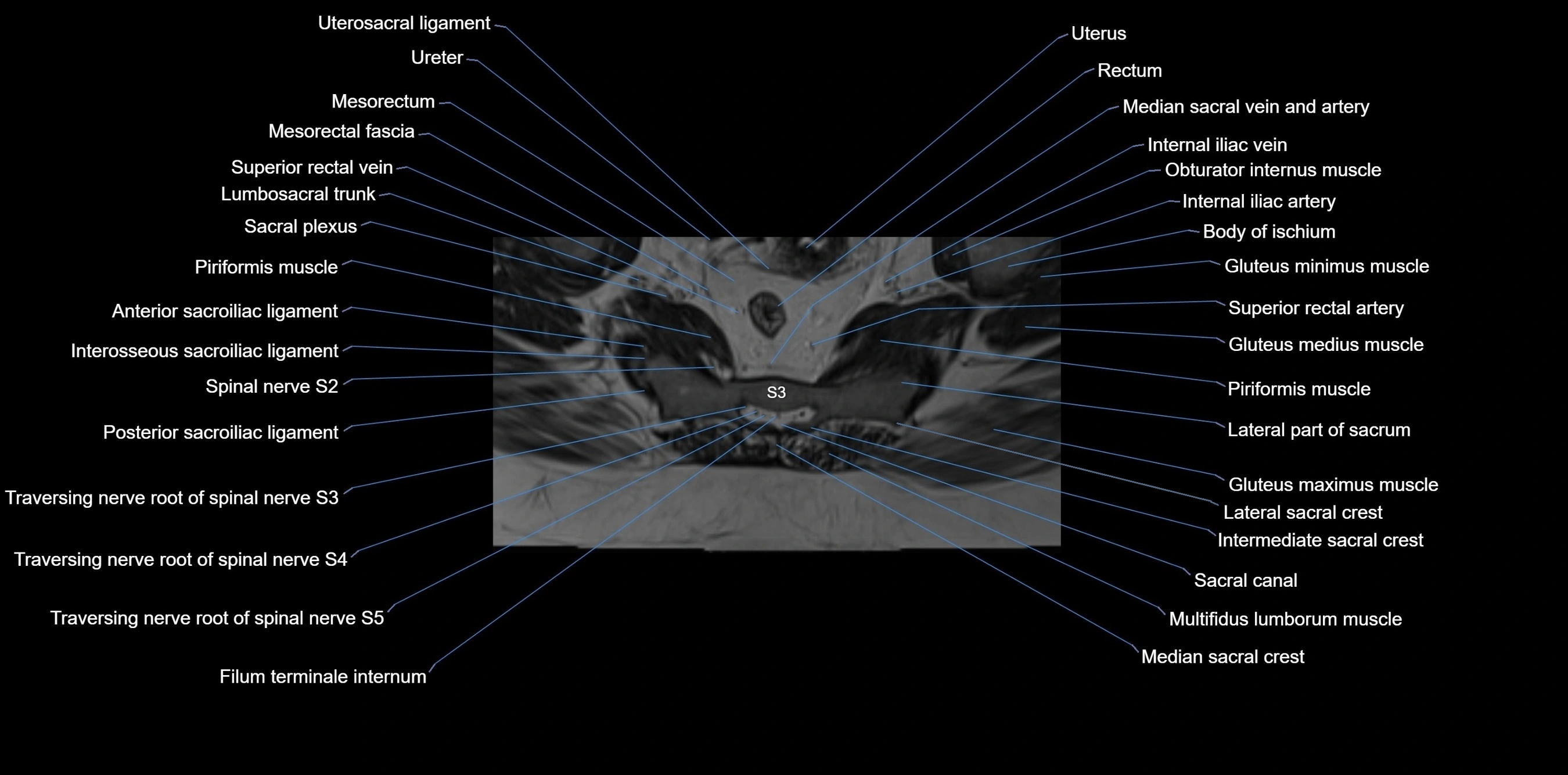 MRI sacrum, coccyx and sacroiliac joint axial cross sectional anatomy 3T  radiology  image-img-00001-00038.webp
